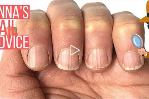 RIDGY NAILS? THE ONLY SOLUTION. [ANNA'S NAIL ADVICE]