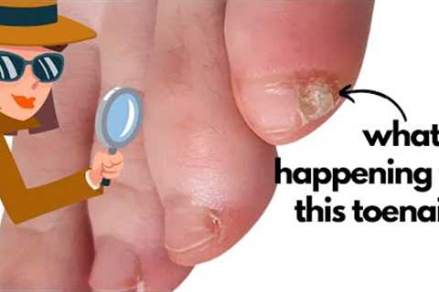 Whats wrong with this baby toenail? [Anna's Nail Advice] 🕵️